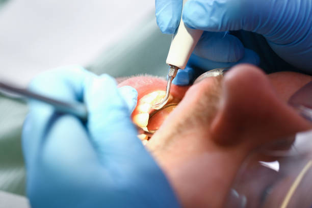 Best Emergency Dental Care for Broken or Chipped Teeth in Durant, MS